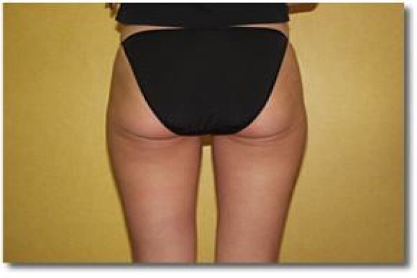 Laser Lipo