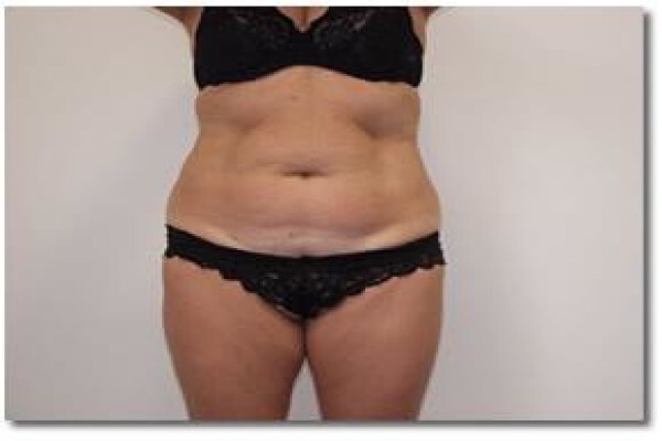 Laser Lipo