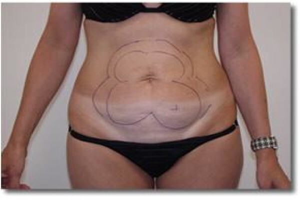 Laser Lipo