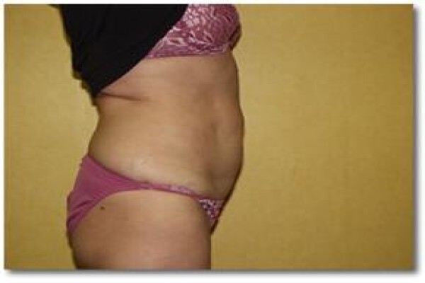 Laser Lipo