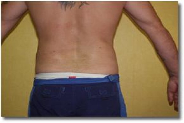 Laser Lipo