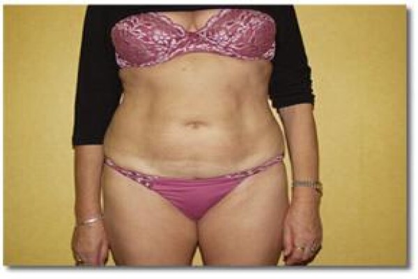 Laser Lipo