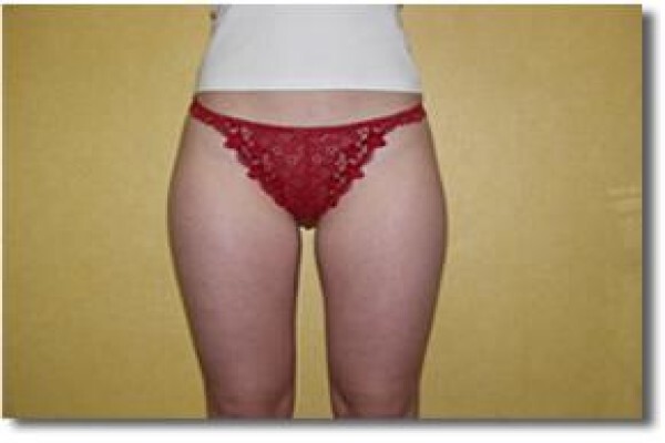 Laser Lipo