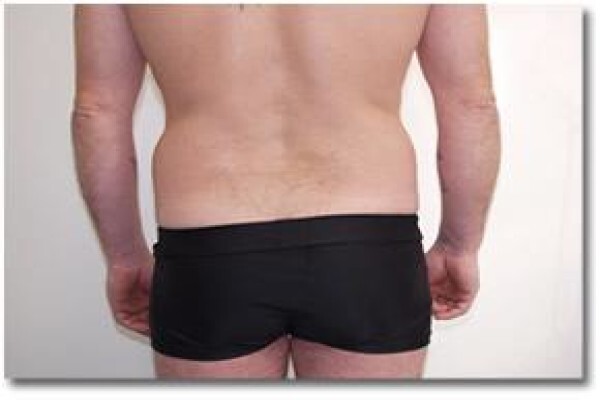 Laser Lipo