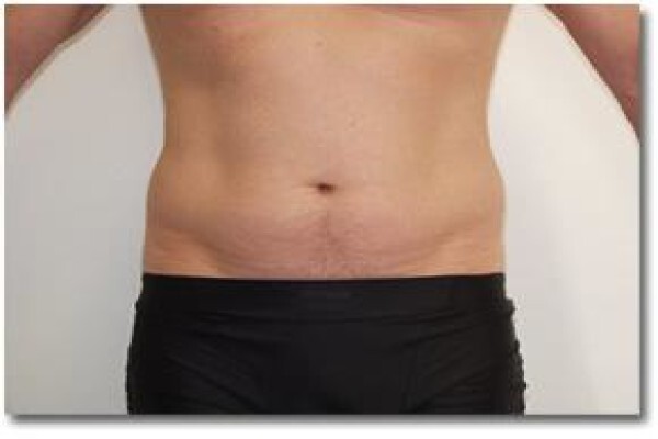 Laser Lipo