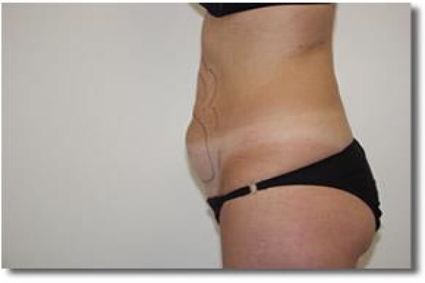 Laser Lipo