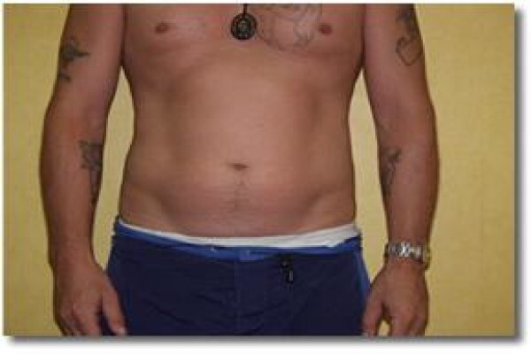 Laser Lipo