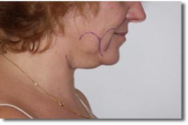 Laser Lipo