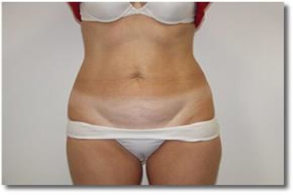 Laser Lipo