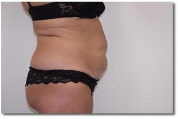 Laser Lipo