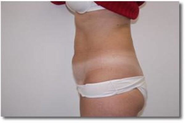 Laser Lipo