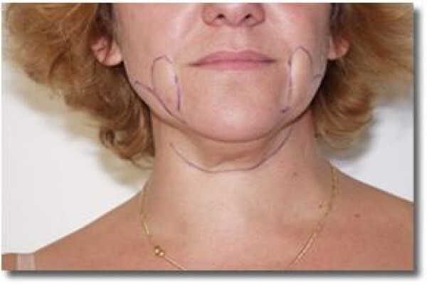 Laser Lipo