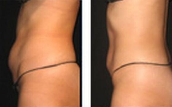 Vaser Liposuction