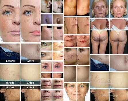 Dermaroller By Xfactor Beauty