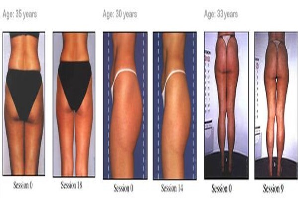 Endermologie Claremont