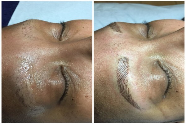 Endermologie Claremont