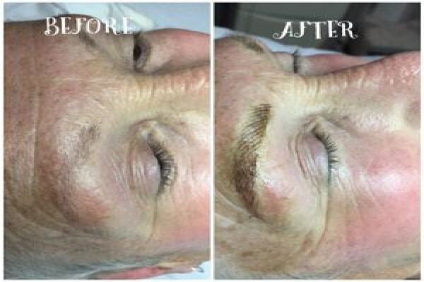 Endermologie Claremont