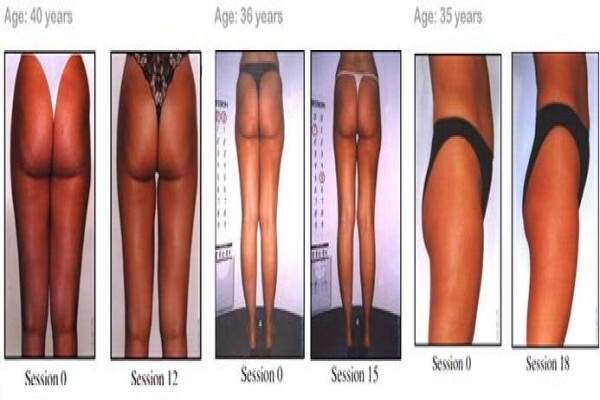 Endermologie Claremont