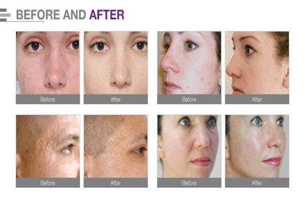 Endermologie Claremont