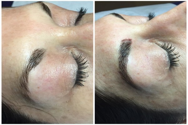 Endermologie Claremont