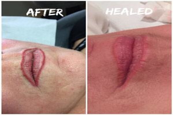 Endermologie Claremont