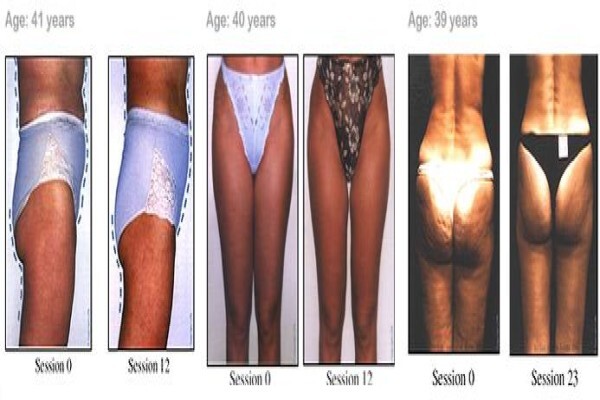 Endermologie Claremont