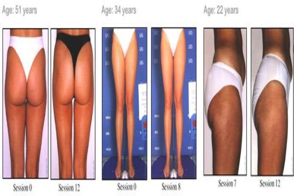 Endermologie Claremont