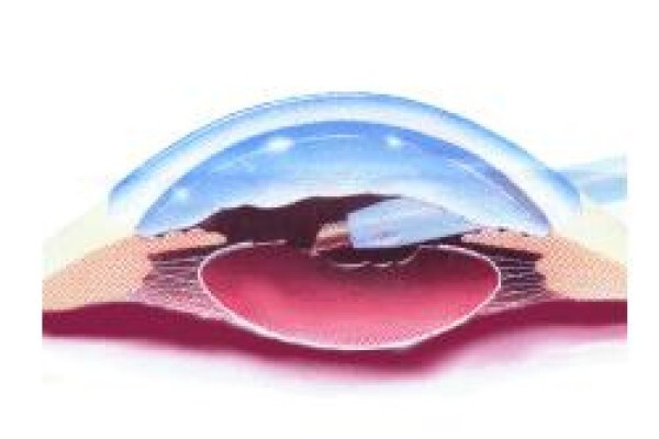 Healthy Eye