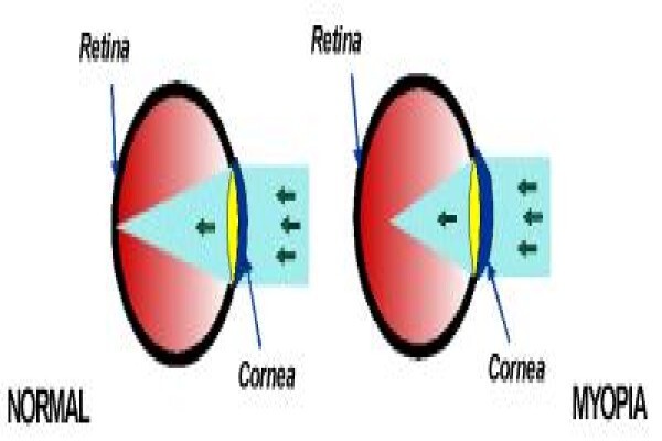 Healthy Eye