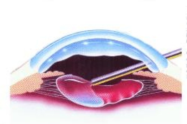 Healthy Eye