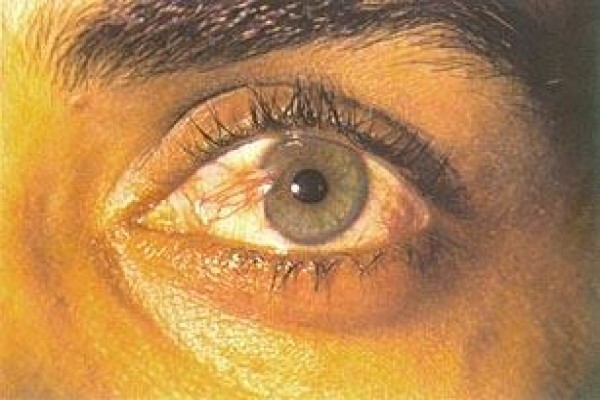Healthy Eye