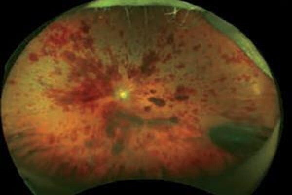 Healthy Eye