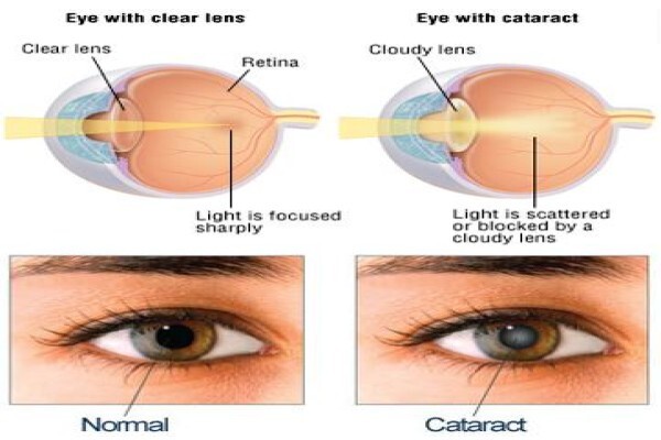 Healthy Eye