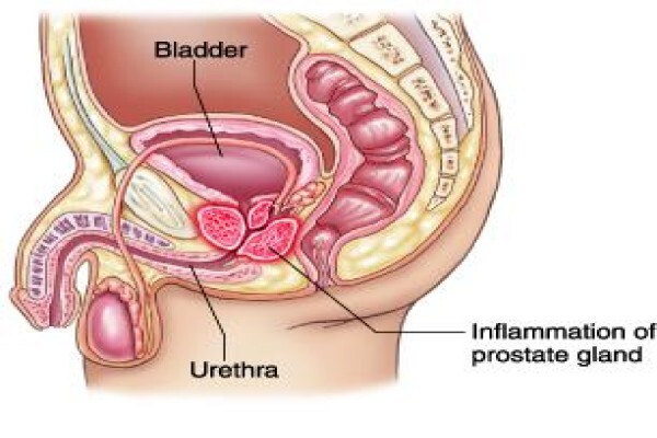 Prostatitis