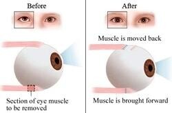 Ophthalmicare