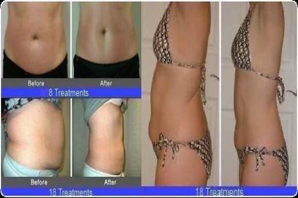 Laser Lipo South Africa