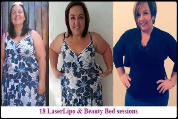 Laser Lipo South Africa