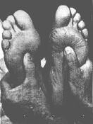 Reflexology 2000